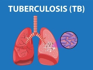 TBC M72