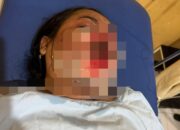 Korban Terpapar Abu Panas Semeru Dirujuk ke RS Pasirian, Pemkab Lumajang